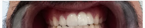 Final Aesthetic Zirconia Restoration